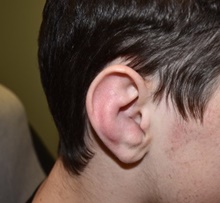 Ear Reconstruction Surgery Before Photo by Rachel Ruotolo, MD; Garden City, NY - Case 41377