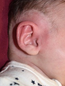 Ear Surgery After Photo by Rachel Ruotolo, MD; Garden City, NY - Case 41379