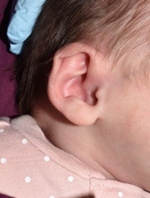 Ear Surgery Before Photo by Rachel Ruotolo, MD; Garden City, NY - Case 41379