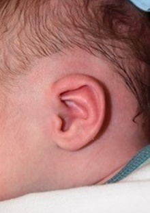 Ear Surgery Before Photo by Rachel Ruotolo, MD; Garden City, NY - Case 41383