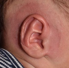 Ear Surgery After Photo by Rachel Ruotolo, MD; Garden City, NY - Case 41384