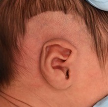 Ear Surgery Before Photo by Rachel Ruotolo, MD; Garden City, NY - Case 41384