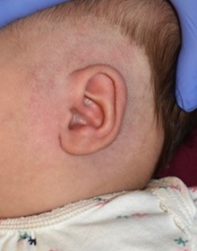Ear Surgery After Photo by Rachel Ruotolo, MD; Garden City, NY - Case 41385