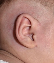 Ear Surgery After Photo by Rachel Ruotolo, MD; Garden City, NY - Case 41385