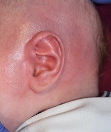 Ear Surgery After Photo by Rachel Ruotolo, MD; Garden City, NY - Case 41386