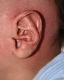 Ear Surgery After Photo by Rachel Ruotolo, MD; Garden City, NY - Case 41951