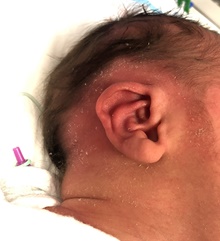 Ear Surgery Before Photo by Rachel Ruotolo, MD; Garden City, NY - Case 41951