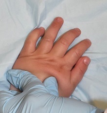 Hand Surgery for Congenital Differences After Photo by Rachel Ruotolo, MD; Garden City, NY - Case 41953