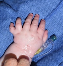 Hand Surgery for Congenital Differences Before Photo by Rachel Ruotolo, MD; Garden City, NY - Case 41953