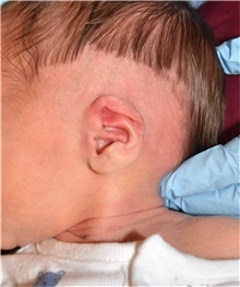 Ear Surgery Before Photo by Rachel Ruotolo, MD; Garden City, NY - Case 41959