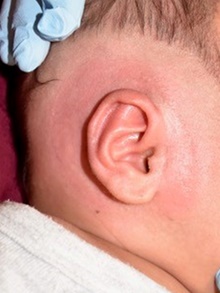 Ear Surgery After Photo by Rachel Ruotolo, MD; Garden City, NY - Case 41960