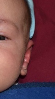 Ear Surgery After Photo by Rachel Ruotolo, MD; Garden City, NY - Case 41961