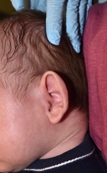 Ear Surgery Before Photo by Rachel Ruotolo, MD; Garden City, NY - Case 41961