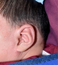 Ear Surgery After Photo by Rachel Ruotolo, MD; Garden City, NY - Case 41964