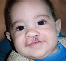 Cleft Lip and Palate Repair Before Photo by Rachel Ruotolo, MD; Garden City, NY - Case 41967