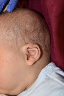 Ear Surgery Before Photo by Rachel Ruotolo, MD; Garden City, NY - Case 41969