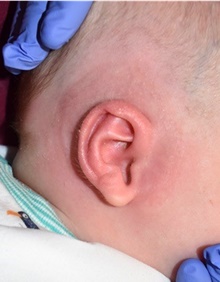 Ear Surgery After Photo by Rachel Ruotolo, MD; Garden City, NY - Case 41969