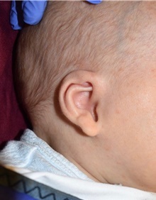 Ear Surgery Before Photo by Rachel Ruotolo, MD; Garden City, NY - Case 41969
