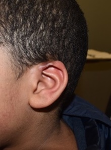Ear Reconstruction Surgery After Photo by Rachel Ruotolo, MD; Garden City, NY - Case 41974