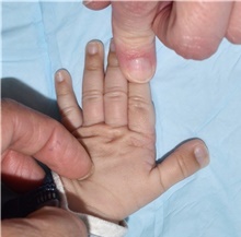 Hand Surgery for Congenital Differences Before Photo by Rachel Ruotolo, MD; Garden City, NY - Case 42045