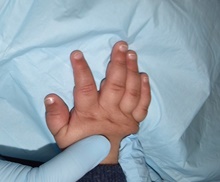 Hand Surgery for Congenital Differences After Photo by Rachel Ruotolo, MD; Garden City, NY - Case 42045