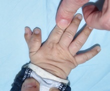Hand Surgery for Congenital Differences Before Photo by Rachel Ruotolo, MD; Garden City, NY - Case 42045