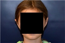 Ear Surgery After Photo by Rachel Ruotolo, MD; Garden City, NY - Case 42053