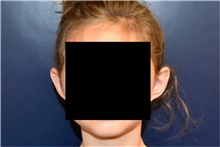 Ear Surgery Before Photo by Rachel Ruotolo, MD; Garden City, NY - Case 42053