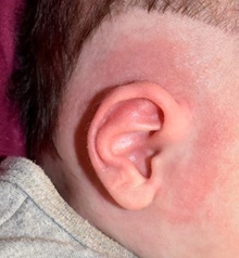 Ear Surgery After Photo by Rachel Ruotolo, MD; Garden City, NY - Case 42056