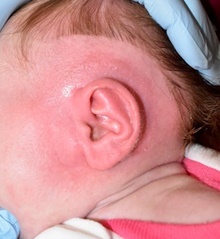 Ear Surgery After Photo by Rachel Ruotolo, MD; Garden City, NY - Case 42474
