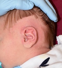 Ear Surgery Before Photo by Rachel Ruotolo, MD; Garden City, NY - Case 42474