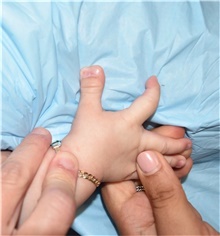 Hand Surgery for Congenital Differences Before Photo by Rachel Ruotolo, MD; Garden City, NY - Case 42477