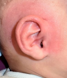 Ear Surgery After Photo by Rachel Ruotolo, MD; Garden City, NY - Case 42487