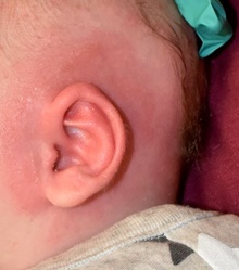 Ear Surgery After Photo by Rachel Ruotolo, MD; Garden City, NY - Case 42490
