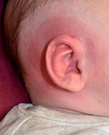 Ear Surgery After Photo by Rachel Ruotolo, MD; Garden City, NY - Case 42490