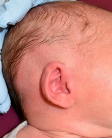 Ear Surgery Before Photo by Rachel Ruotolo, MD; Garden City, NY - Case 42490