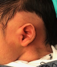 Ear Surgery Before Photo by Rachel Ruotolo, MD; Garden City, NY - Case 43374