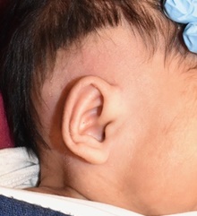 Ear Surgery After Photo by Rachel Ruotolo, MD; Garden City, NY - Case 43374
