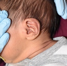 Ear Surgery Before Photo by Rachel Ruotolo, MD; Garden City, NY - Case 43377