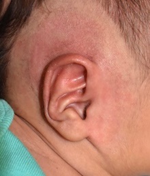 Ear Surgery After Photo by Rachel Ruotolo, MD; Garden City, NY - Case 43377