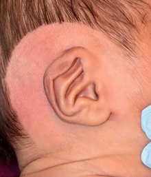 Ear Surgery Before Photo by Rachel Ruotolo, MD; Garden City, NY - Case 43377