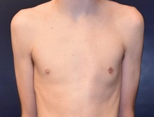 Male Breast Reduction After Photo by Rachel Ruotolo, MD; Garden City, NY - Case 43383