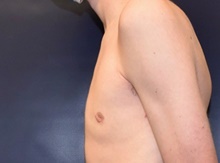 Male Breast Reduction After Photo by Rachel Ruotolo, MD; Garden City, NY - Case 43383