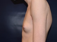 Male Breast Reduction Before Photo by Rachel Ruotolo, MD; Garden City, NY - Case 43383