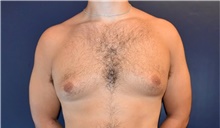 Male Breast Reduction Before Photo by Rachel Ruotolo, MD; Garden City, NY - Case 43384