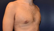 Male Breast Reduction After Photo by Rachel Ruotolo, MD; Garden City, NY - Case 43384