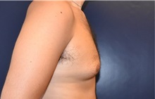 Male Breast Reduction Before Photo by Rachel Ruotolo, MD; Garden City, NY - Case 43384