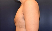 Male Breast Reduction After Photo by Rachel Ruotolo, MD; Garden City, NY - Case 43384
