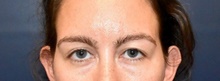 Eyelid Surgery Before Photo by Rachel Ruotolo, MD; Garden City, NY - Case 43389