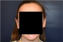 Ear Surgery After Photo by Rachel Ruotolo, MD; Garden City, NY - Case 43392
